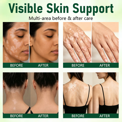 Alcuras® Herbal Vitiligo Cream