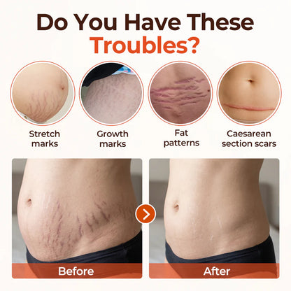 Alcuras® SilkStretch Natural Stretch Mark & Scar Oil ( Imported )