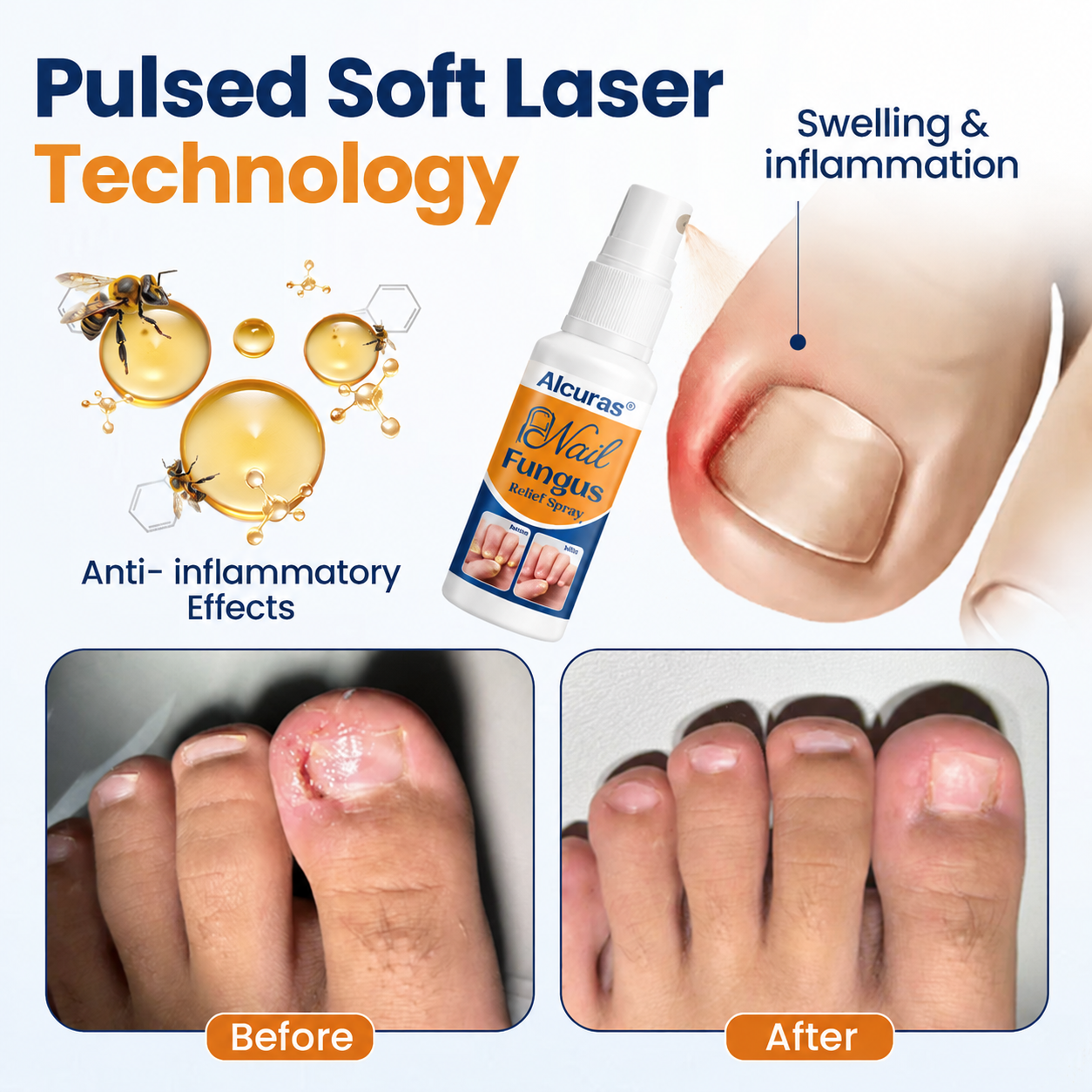 Alcuras® Nail fungus relief spray