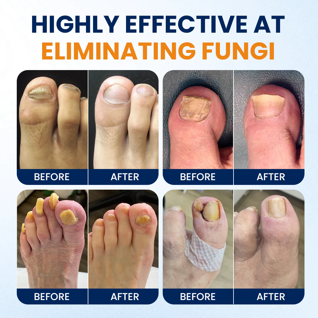 Alcuras® Nail fungus relief spray