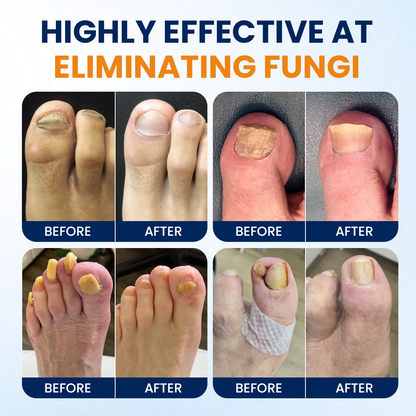 Alcuras® Nail fungus relief spray
