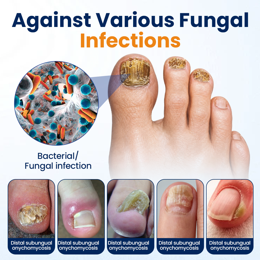 Alcuras® Nail fungus relief spray