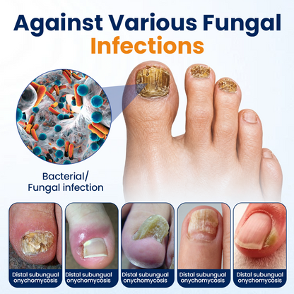 Alcuras® Nail fungus relief spray