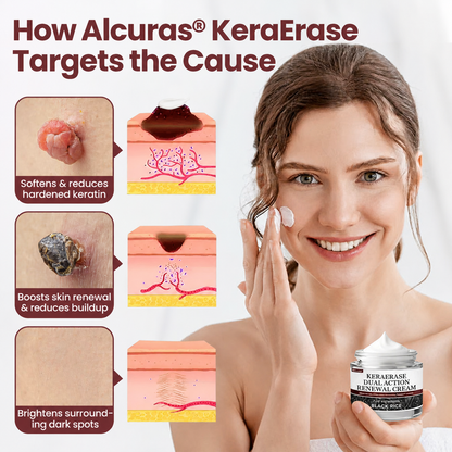 Alcuras® KeraErase Dual-Action Renewal Cream