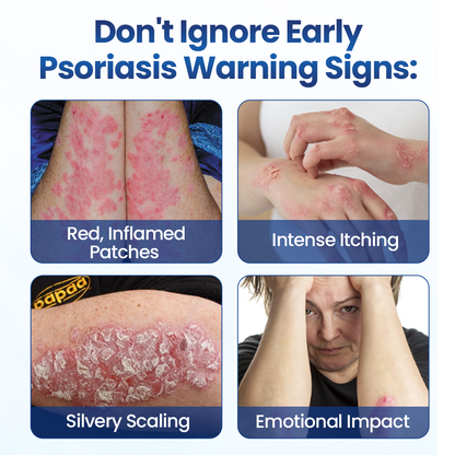 Alcuras®  PsoriaMucin No-Rub Itch & Flake Relief Mist