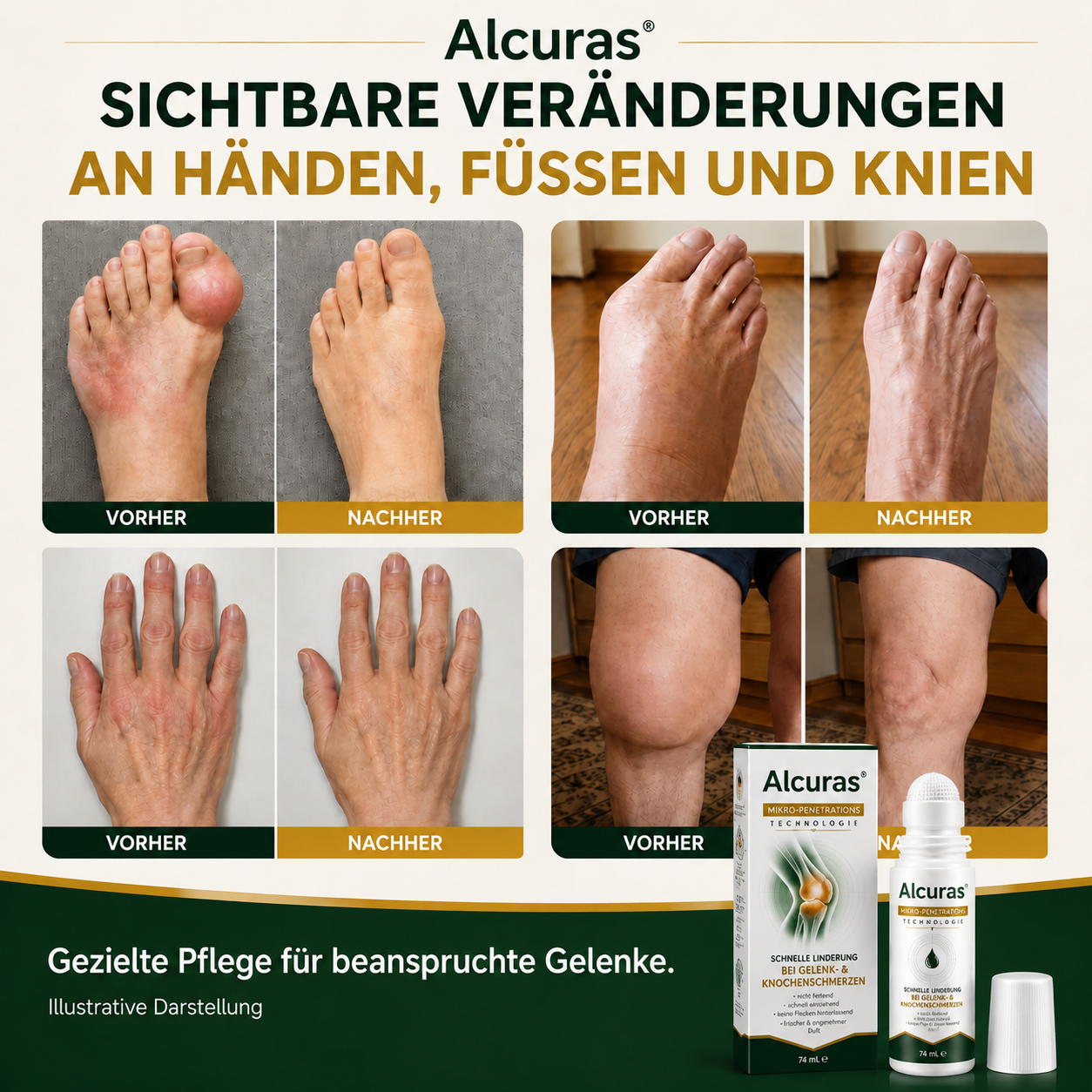 Alcuras® 0,05 mm Mikro-Nadel-Roller zur Unterstützung der Knochen- und Gelenkregeneration (0.05mm)