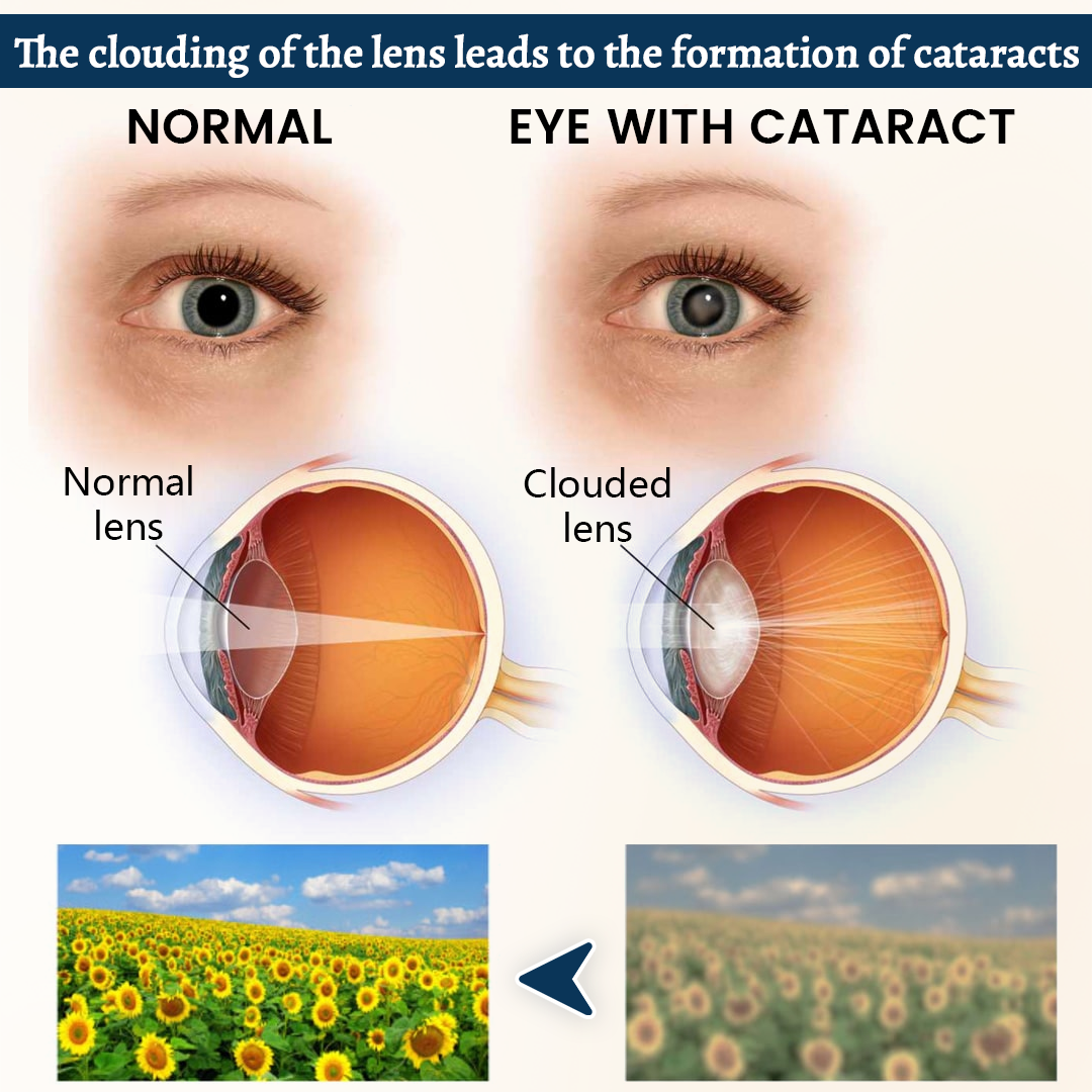 Alcuras® Vision Support Eye Patch👁️✨