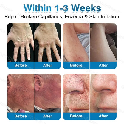 🇦🇺🏆✅️🏃Alcuras® VeinRepair Microneedle Patch Roll⚡Instant Relief, Long-Term Results