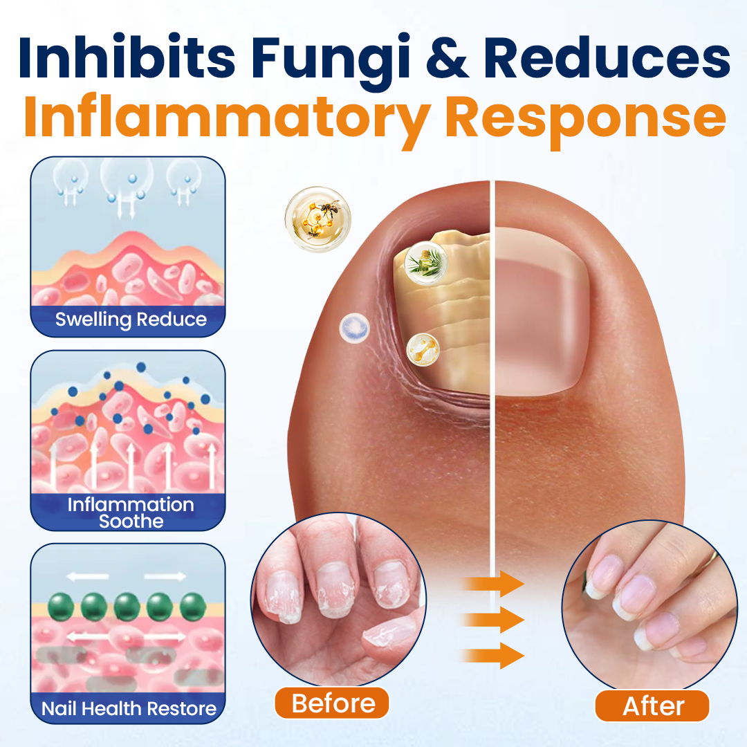 Alcuras® Nail fungus relief spray