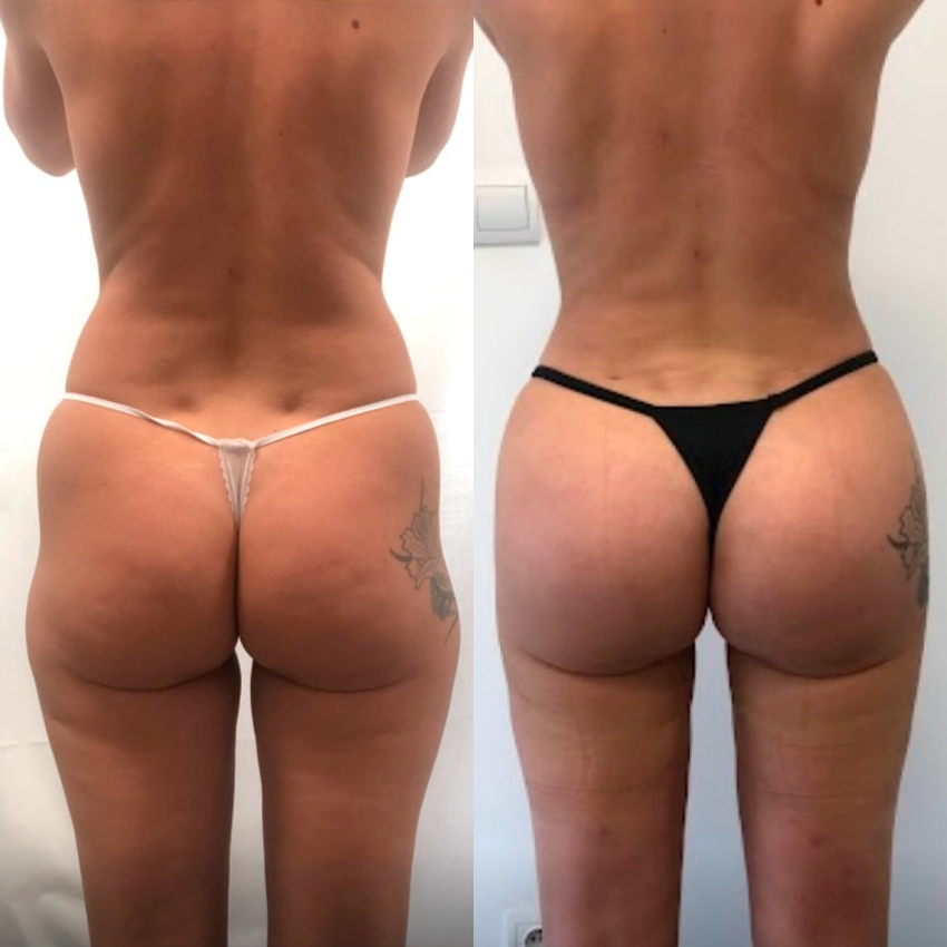 Alcuras® Curvessa Micro-Needle Sculpting Patches
