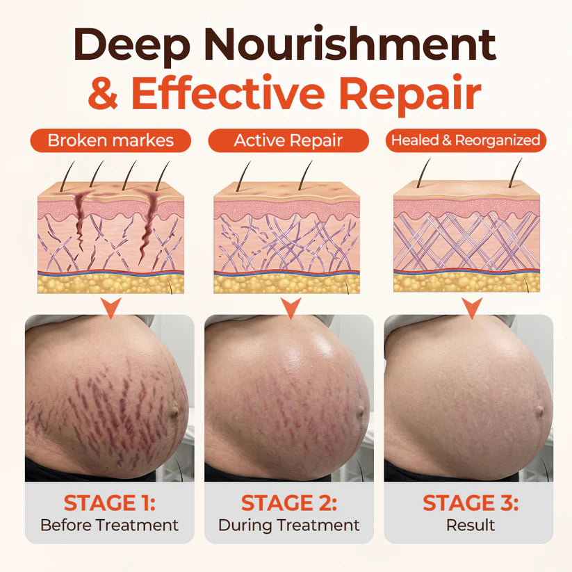 Alcuras® SilkStretch Natural Stretch Mark & Scar Oil ( Imported )