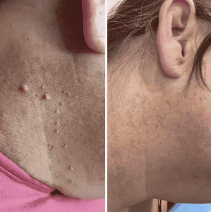 Alcuras® Painless Skin Tag Removal Kit