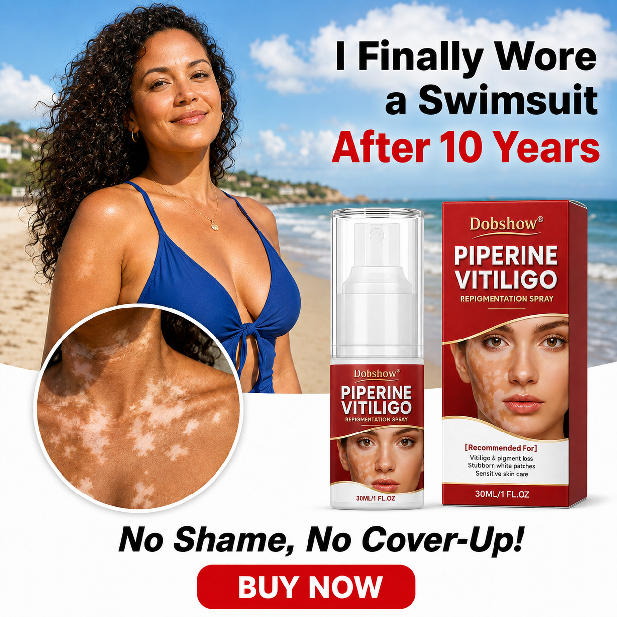🔥100K+ SOLD | Alcuras® Advanced Piperine Vitiligo Repigmentation Spray — 👨‍⚕️✅Upgraded Steroid-Free Botanical Formula